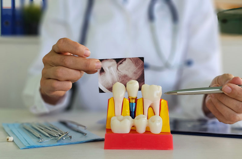 Dental professional examines tooth model and X-ray to assess patient condition and treatment options.